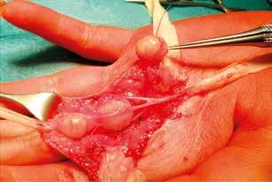 removal of one of the tumours, C) radial digital nerve after resection of the tumours, D) tumour of