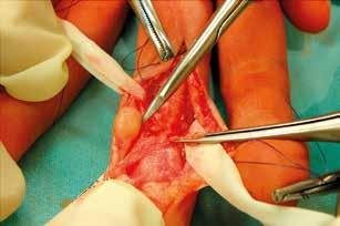 interphalangeal joint and another nodule located on the opposite side at the level of the base of the