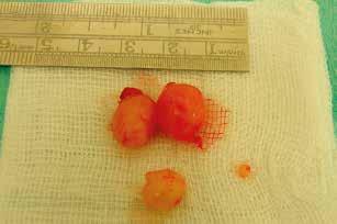 Surgical treatment was divided into two stages in order to avoid vast dissection of tissues of the third