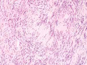 Segmental schwannomatosis A B Fig. 3. Histopathological examination results: A) neurilemmoma Antoni A, H&E stain, 100 magnification; B) immunohistochemical expression of S-100 protein in Schwann cell.