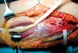 Segmental schwannomatosis A B C D