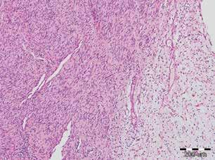 Segmental schwannomatosis prompted us to perform detailed histopathological