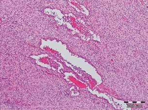 Ancient schwannoma was diagnosed on the basis of the following features: