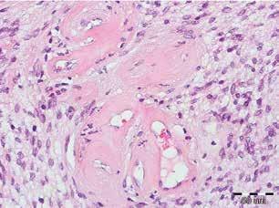 In our histopathological samples no calcification or hemorrhagic areas were