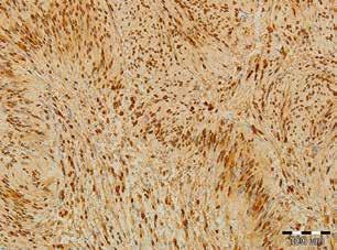 cells represented by a Verocay body ( Antoni A ) (left side of the image) and