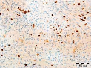 formation, C) irregular vessels with hyalinized walls, D) marked cellular and