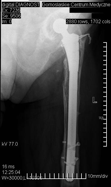 Nowak M. i wsp. Analiza radiologiczna leczenia złamań okołoprotezowych Ryc. 1.
