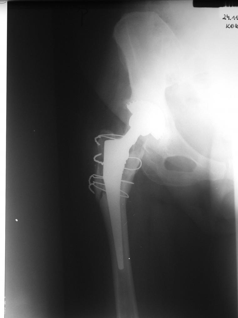 The presence of a linear radiolucency between stem and adjacent bone and subsidence of femoral stem with broken locking screws Ryc. 2.