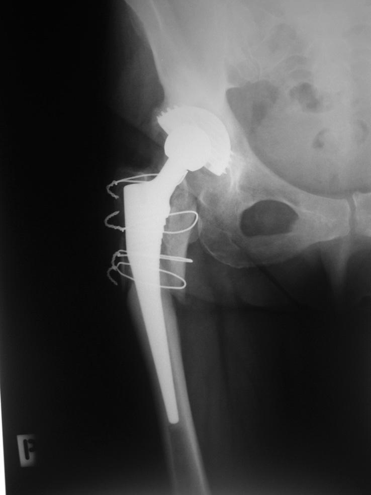 Nowak M. et al. Radiological Analysis of Treatment the Periprosthetic Fractures Ryc.3. Przemieszczenie odłamów z osteolizą krętarza większego wokół drutów. RTG kontrolne po roku Fig. 3.