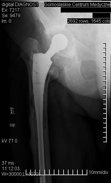 Linia przejaśnienia na granicy kość cement, cement implant oraz ogniska osteolizy Fig. 4. The presence of a linear radiolucency between cement and adjacent bone as well as between stem and cement.