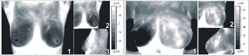 Przykładowe termogramy wykorzystywane przy wykrywania raka sutka: 1 obraz w ustawieniu na wprost kamery obejmujący obie piersi, oraz obrazy piersi lewej w ustawieniach: 2 - na wprost oraz 3