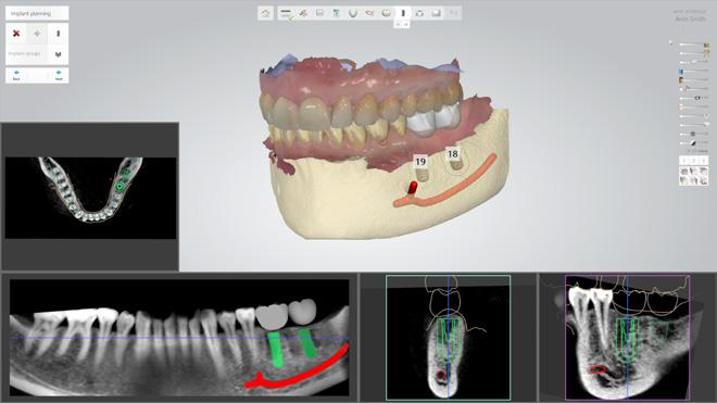 jakość produktu finalnego. Ponadto poprawiono przycinanie belek implantów do dziąseł, uzyskując w ten sposób udoskonalony rezultat pracy.