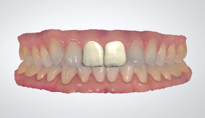Swobodne wyrównywanie skanów w narzędziu Dental Designer Teraz możliwe jest łatwe wyrównywanie skanu przed preparacją oraz skanu preparacji (np.