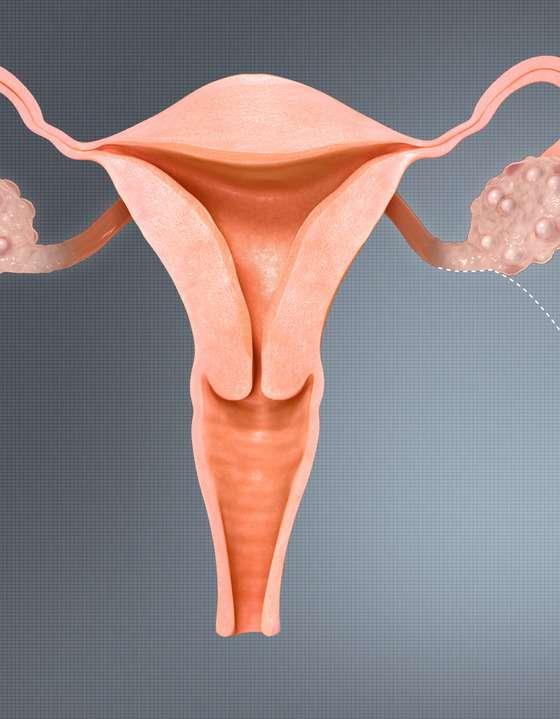 Endometrioza Leczenie: - chirurgiczne - hormonalne Nutraceutyki: - omega-3, witamina B1,