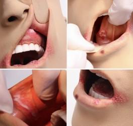 materiału Fantom posiada bardzo różne patologie jamy ustnej i jej okolic Patologie obejmują: Kątowe zapalenie warg, Ropień
