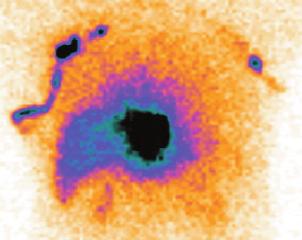 Material and Methods: From 1 December 1999 to 31 July 2003 in the Department of Surgical Oncology, Medical University of ódÿ, 100 patients with trunk skin melanoma underwent the sentinel node biopsy.