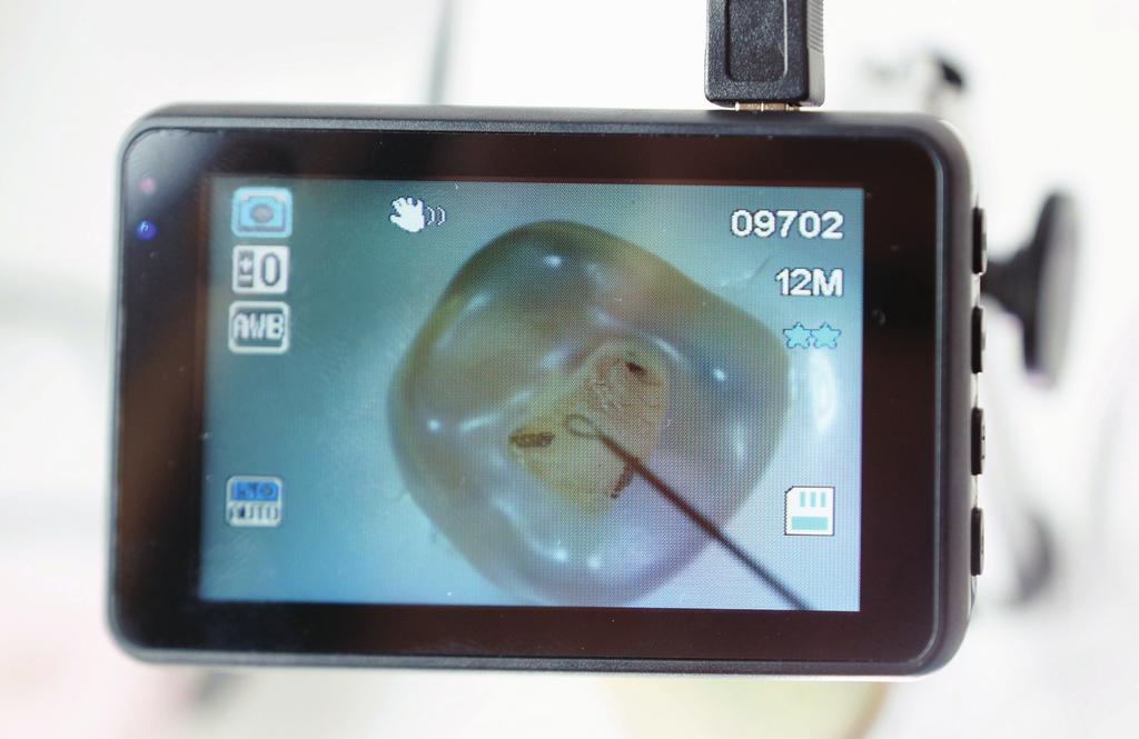 VI. Nauka pracy BTR Pen w szeroko opracowanym kanale korzeniowym z luźno osadzonym fragmentem załamanego instrumentu I stopień trudności Learning to work with BTR PEN in a wide root canal with