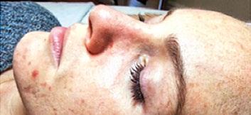 3 Anti Acne to linia kosmetyków przeznaczona do zabiegów w gabinecie, których celem jest redukcja trądziku zapalnego.