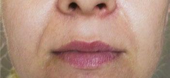stężeniach: Skin Revital 1 40% ph 1,5 Skin Revital 2 60% ph 0,8 działa odświeżająco na naskórek, skutecznie spłyca