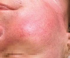 syntezę kolagenu i wzmacnia strukturę skóry Lacto Peel linia kosmetyków przeznaczonych do pielęgnacji cery wrażliwej.