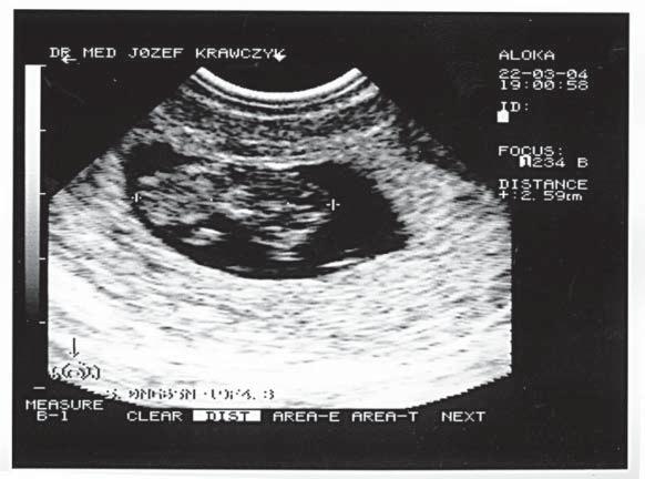 Prenatalna diagnoza ci¹ y heterotopowej opis przypadku 57 DYSKUSJA Czynniki ryzyka ci¹ y heterotopowej W roku 1948 ryzyko wyst¹pienia ci¹ y heterotopowej oceniono na 1: 30 000 ci¹ [3].