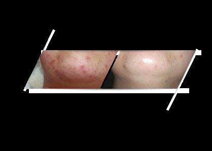 Monopeelingi Peel Mission - galeria efektów SIMPLE WAY TO GET PERFECT SKIN seria 6 zabiegów PYRUVIC PEEL + ANTI ACNE