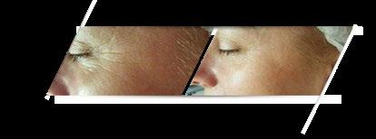 Demakijaż Tonizacja 1 2 3 Płyn Remover Micelarny CERA CERA SUCHA/ SUCHA/Up Up Washing B-Like Tonic HYPERPIGMENTATION SKIN 4 Krem B-Like Cream Skoncentrowana kuracja
