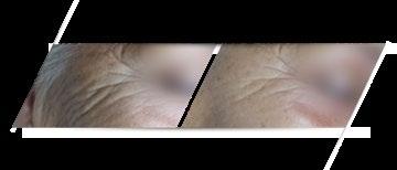 Zabiegi setowe Lift Peel - galeria efektów 1 zabieg Anti Age + Lift Peel 1 zabieg Skin Revital + Lift Peel przed zabiegiem po zabiegu przed zabiegiem po zabiegu - pielęgnacja w domu W celu