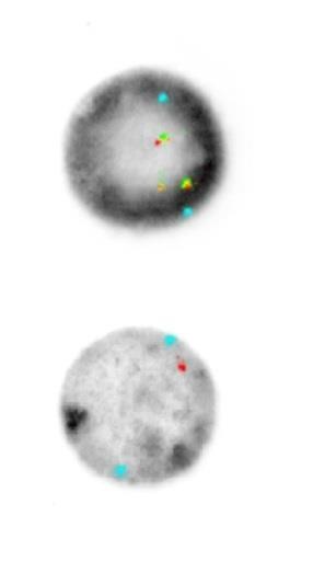 centromerowej CEP-11-Aq widocznej w kolorze niebieskim, rozdzielczej MLL(KMT2A) w kolorze żółtym oraz telomerowej TelVysion 11q w kolorze czerwonym a. Duża duplikacja dup(11)(q13q23.