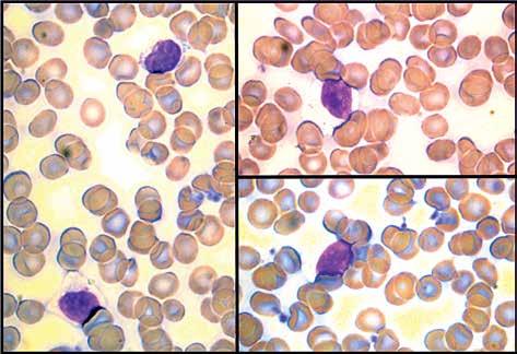 Hematologia 2015, tom 6, nr 3 A B C Rycina 1A C. Pacjent WW; duże ziarniste limfocyty w rozmazie krwi obwodowej Figure 1A C. Patient WW; large granular lymphocytes in peripheral blood smears Rycina 2.