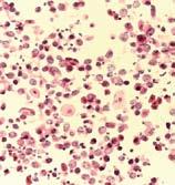 A B A B Rycina 2. Obraz cytologiczny osadu moczu w 3. dniu po przeszczepieniu nerki: A osad bez komórek atypowych H-E 100 B osad z komórkami atypowymi H-E 400 Figure 2.