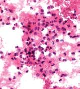 Komórki nabłonka przejściowego z wtrętami jądrowymi wirusa Polyoma (decoy cells) A H-E 100 B H-E 1000 Figure 3. Urinary sediment.