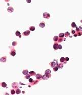 A Rycina 5. Osad moczu: A decoy cells H-E 200 B rak urotelialny H-E 200 Figure 5.