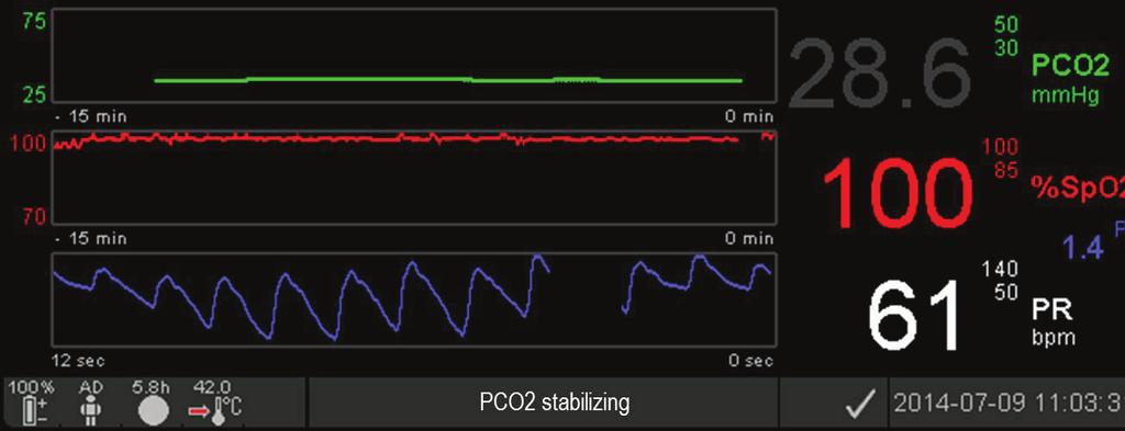Po wykryciu Czujnika na pacjencie SDM rozpoczyna monitorowanie, a włączone parametry stabilizują się.