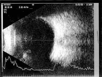 Proliferative Vitreoretinopathy PVR), które wymagało witrektomii.