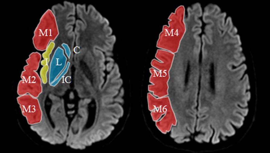 Radiologiczne predyktory skutecznej trombektomii badanie SWIFT PRIME Przewaga trombektomii po rtpa nad izolowanym zastosowaniem rtpa Samodzielność w przypadku skrzepliny 8 mm: 71% vs 43% (p=0,005)