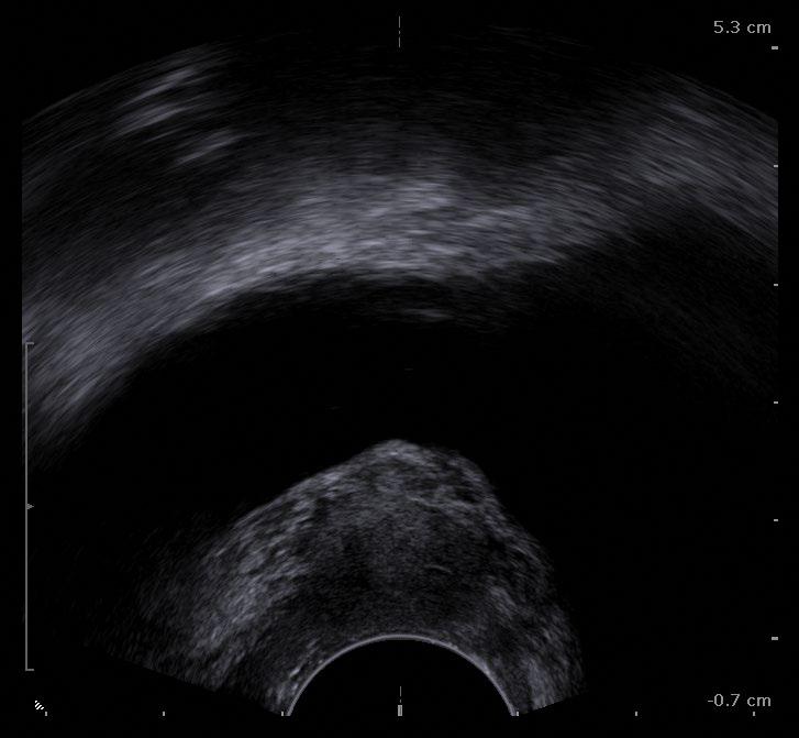 Śródoperacyjna zmiana sposobu postępowania na podstawie obrazu ultrasonograficznego przyzwojaka pęcherza moczowego opis przypadku Ryc. 4.