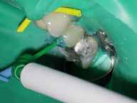 biokompatybilność W przypadku endodontycznych materiałów do wypełnień, pozostających w organizmie przez wiele lat, ważne jest, że nie ma żadnych działań