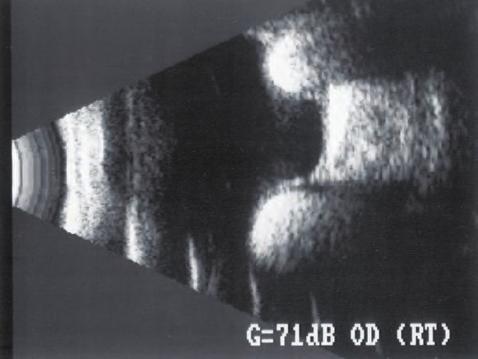 5.67. Nierównomierne wgłobienie ściany gałki ocznej uzyskane za pomocą dwóch plomb zachodzących na siebie (strzałka niebieska), przekrój podłużny Ryc. 5.68.