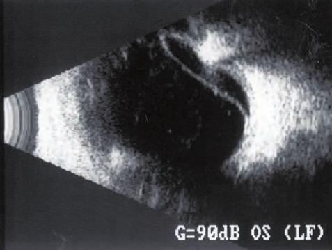 b) nieobjęcie przedarcia/otworu plombą (ryc. 5.71.) UWAGA!