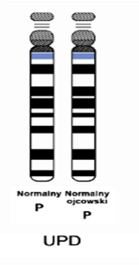 Disomia uniparentalna lub jednorodzielska (UDP) - czyli nieprawidłowy stan, w którym obie kopie genów danego chromosomu są odziedziczone po jednym z rodziców (w przypadku