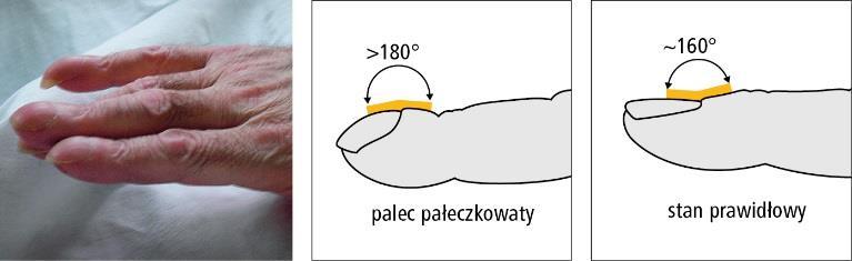 Palce pałeczkowate