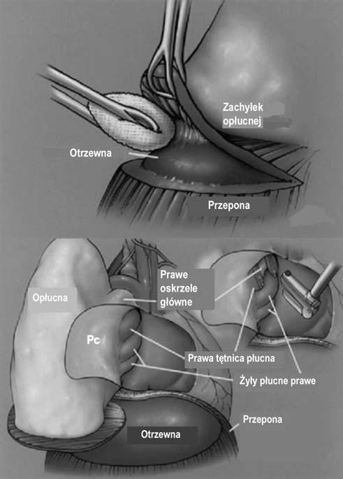 Miejsce chirurgii w leczeniu skojarzonym złośliwego międzybłoniaka opłucnej A B Ryc. 1.