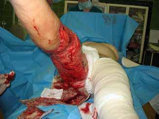 Prace oryginalne A B Figure 2A-B. The temporary MBBD dressing applied onto the wound immediately after excision/debridement.