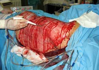 Prace oryginalne A B Figures 3A B. Early excisional therapy of burn wound using electric dermatome followed by water jet technology wound debridement Ryciny 3A B.