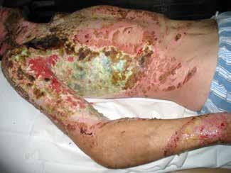 Prace oryginalne A B Figures 4A-B. Late debridement of infected burn wound with water jet technology (no sharp excision) Ryciny 4A-B.