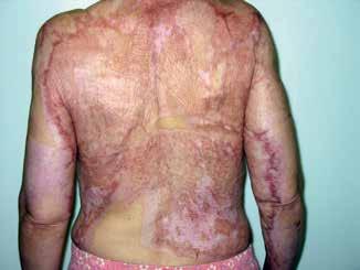 Prace oryginalne G H Figures 6G H. Final result of delayed grafting Ryciny 6G H. Efekt końcowy odroczonej rekonstrukcji burns and wounds of different origin.