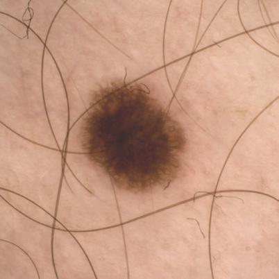 POSTACIE KLINICZNO-HISTOLOGICZNE: CZERNIAK IN - SITU: Jest to najłagodniejsza oraz