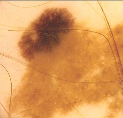 LMM - (lentigo maligna melanoma) czerniak wywodzący się z plamy soczewicowatej. Plamy soczewicowate powstają ze zwiększonej ilości komórek melanocytarnych w naskórku.