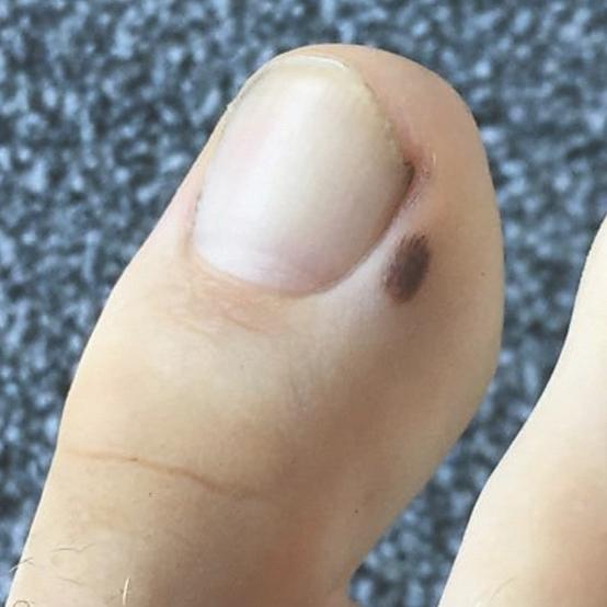 Biopsja wycinająca polega na wycięciu zmiany optymalnie z marginesem 1-3mm. Następnie ranę biopsyjną zaszywa się.